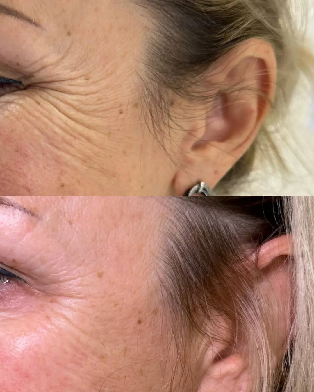 Antes y después de patas de gallo con toxina de precisión en Rë Med Center