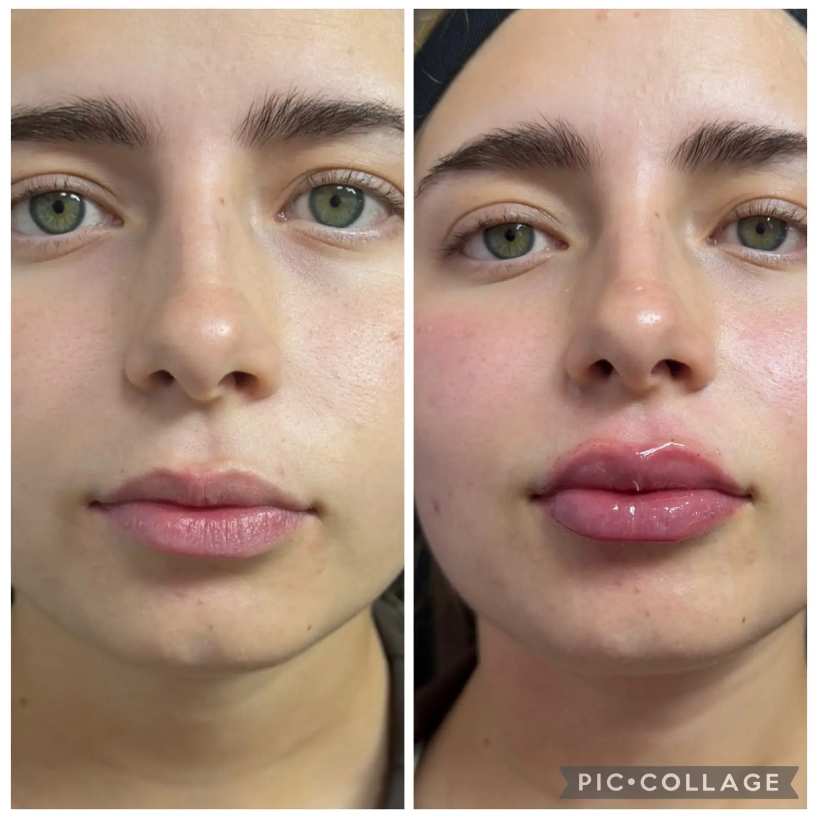 Resultado antes y después · Ácido Hialurónico en labios · Sofía · Rë Med Center